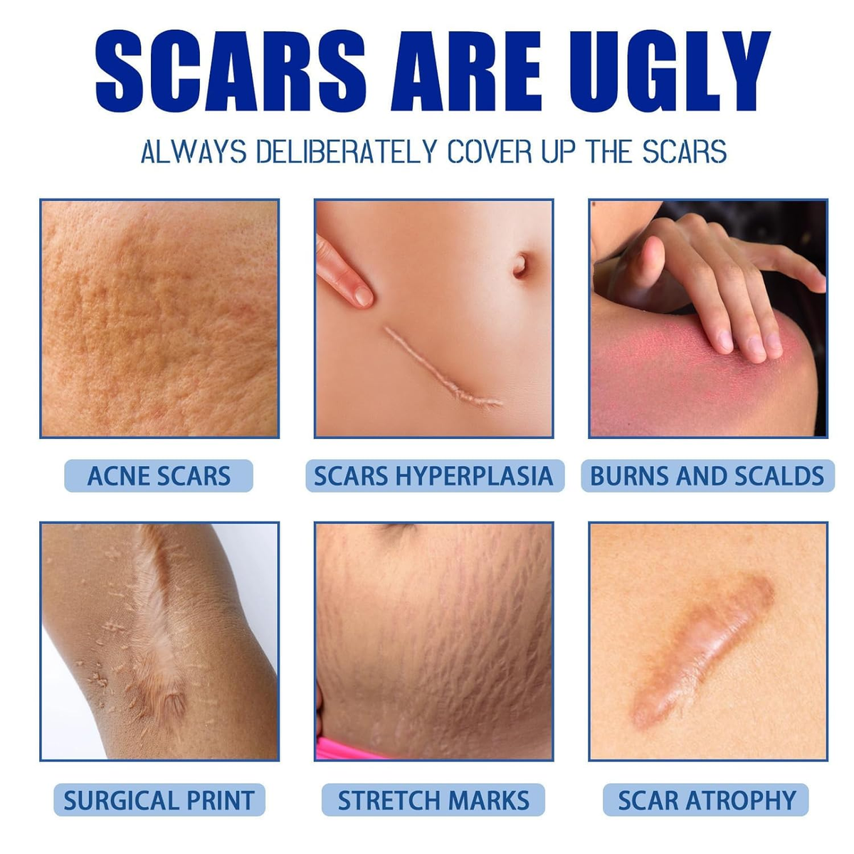 🔥Last Day 50% OFF - 🩹Alcuras® Medical Grade Silicone Scar Cream – Smooth Scars Fast!